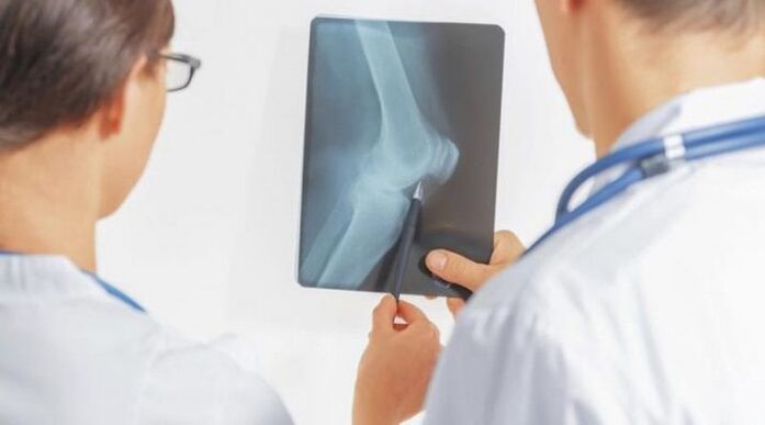 After the necessary diagnosis of arthrosis of the knee joint, doctors prescribe a complex treatment