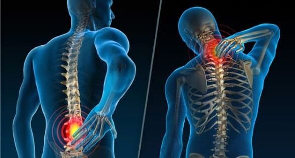 Signs of the development of osteochondrosis - pain in the neck and lower back