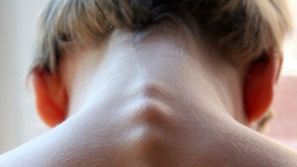 vertebrae