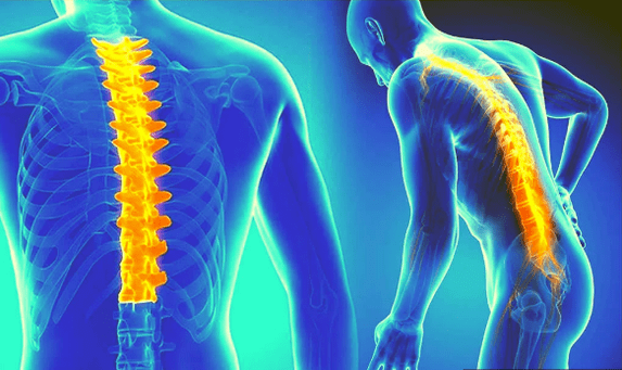 The spine osteochondrosis