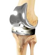 Common prosthetics