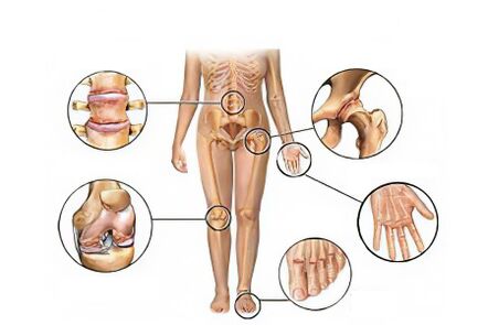 Arthritis