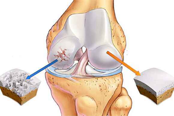 What is arthrosis
