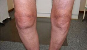 symptoms of arthrosis