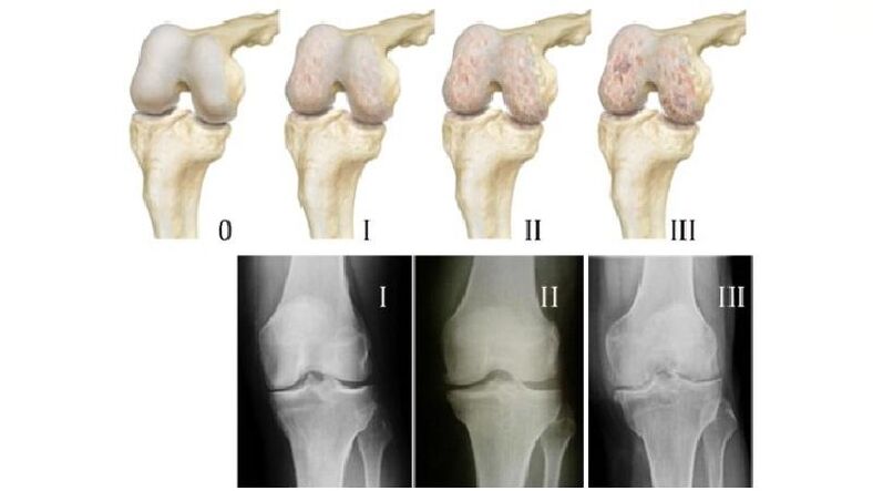 Stages of arthrosis of the knee joint on radiographs