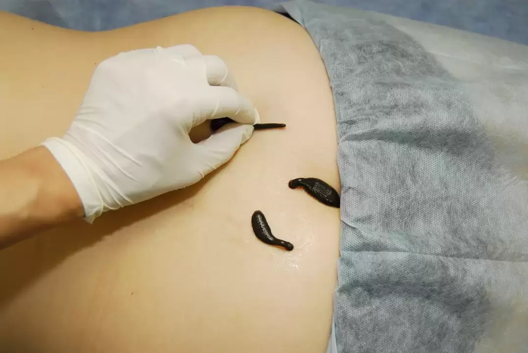placement of leeches in case of lumbar osteochondrosis
