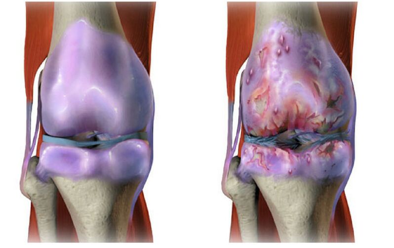 healthy cartilage and destruction of the knee joint with arthrosis