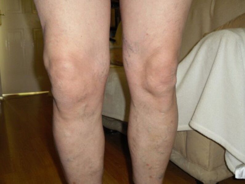 healthy knees and arthrosis of the knee joint