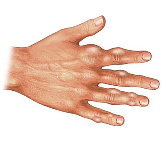Deposit of uric acid crystals in the soft tissues of the fingers in gouty arthritis