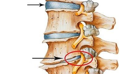 Developmental stages of cervical osteochondrosis