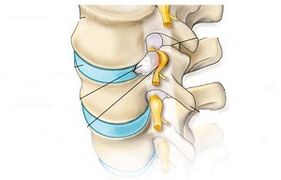 The main symptoms of cervical osteochondrosis