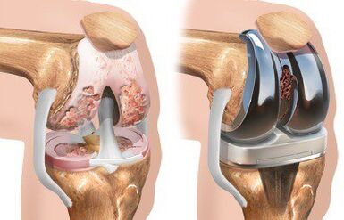 Knee arthroplasty with gonarthrosis